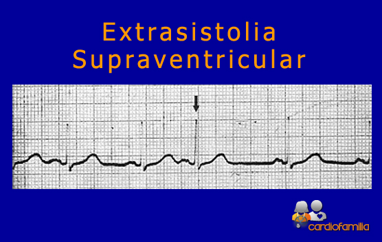 SUPRAVENTRICULAR