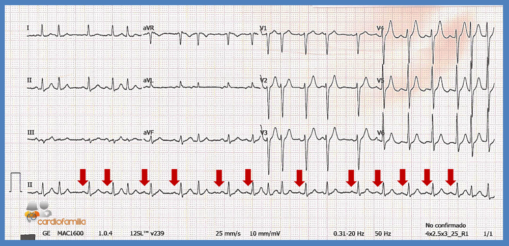 ECG febrero 2017 result
