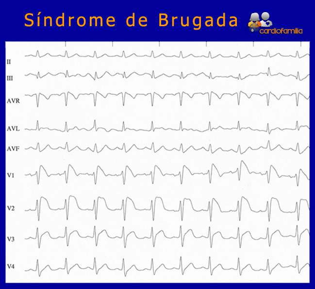 Sindrome-de-Brugada-ECG-cardiologia-cardiofamilia