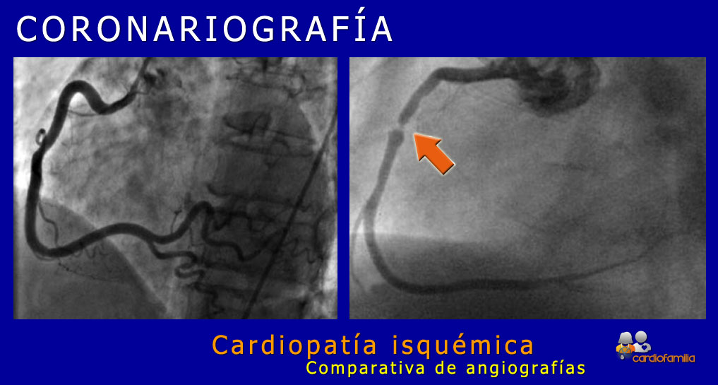 coronariografia x580 www.cardiofamilia.org