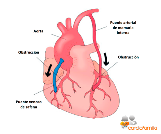 revascularizacion aortocoronaria