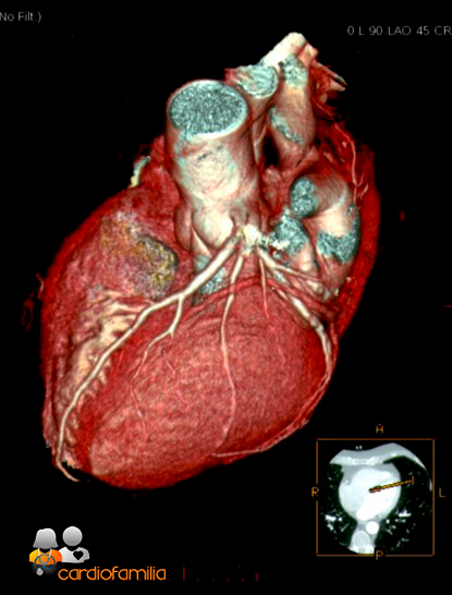 tomografia computerizada multicorte cardiofamilia