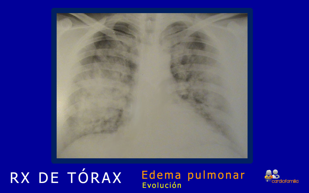 RXtorax edema agudo de pulmón