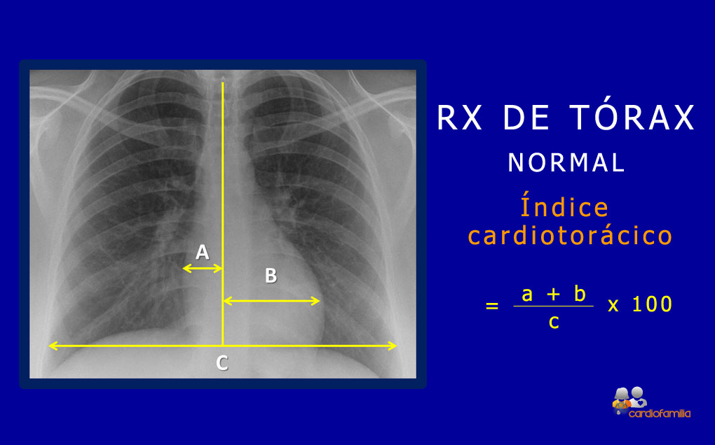 RX torax normal cardiologia cardiofamilia