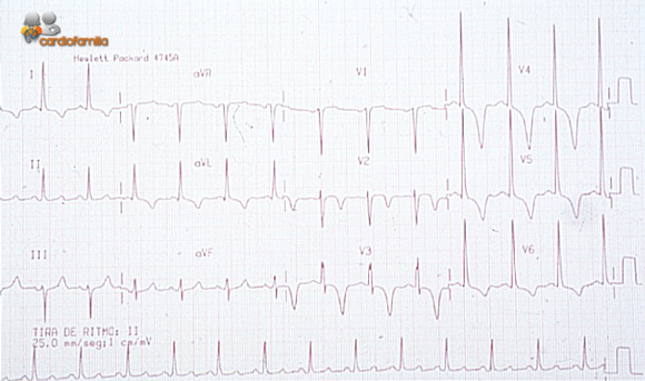 ECG miocardiopatia-hipertrofica