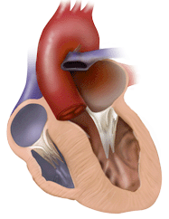 miocardiopatia hipertrofica