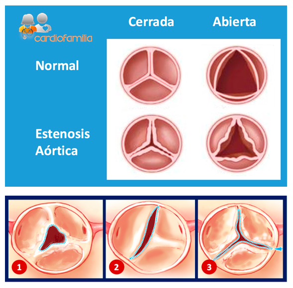 estenosis aortica