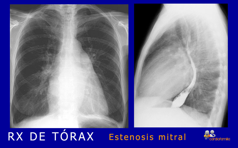 RX_torax_estenosis_mitral_x580_www.cardiofamilia.org