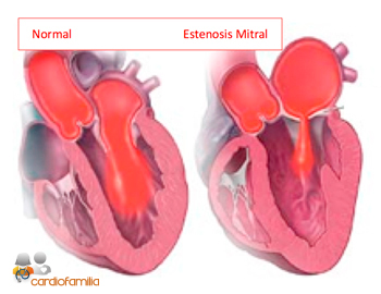 estenosis mitral cardiofamilia