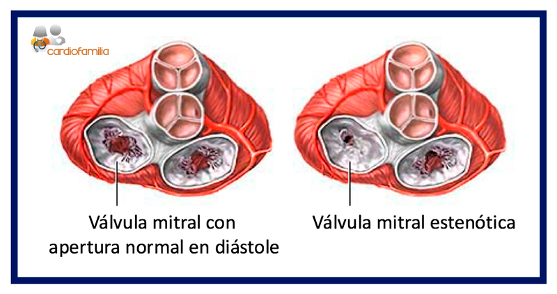 valvula mitral estenotica cardiofamilia