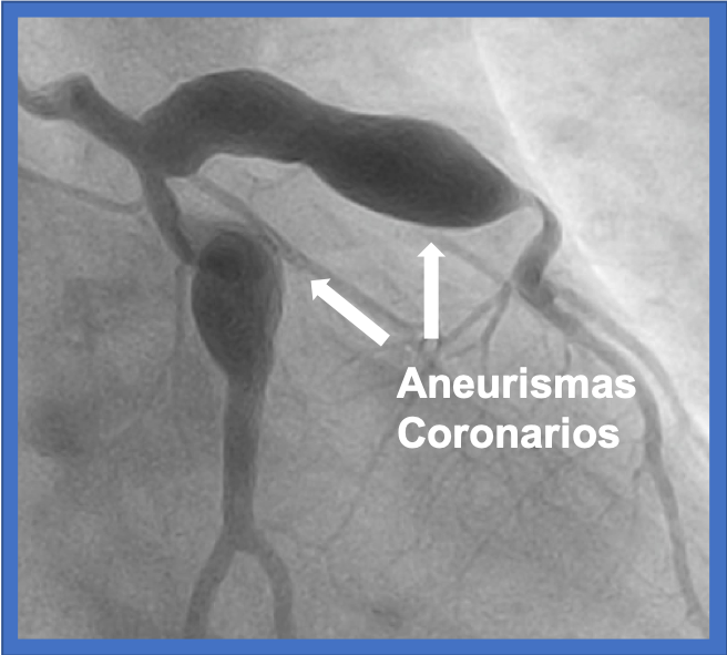 aneurisma coronario cardiofamilia